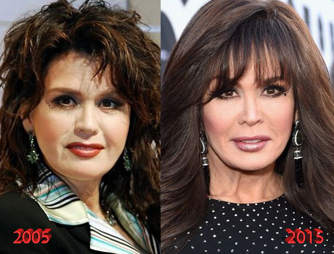 Marie Osmond Plastic Surgery is it really just Botox?