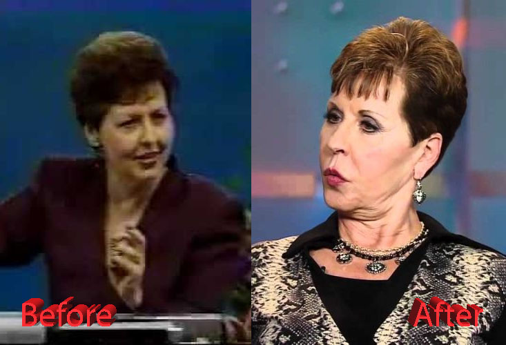 Joyce Meyer Plastic Surgery A Huge Flop