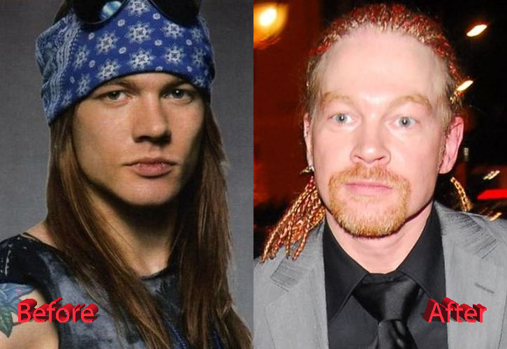 axl rose before and after