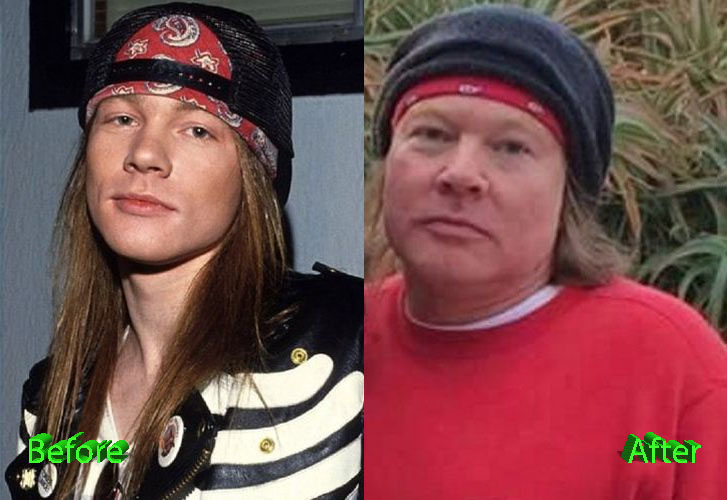 Axl-Rose-Plastic-Surgery-Before-and-Afte