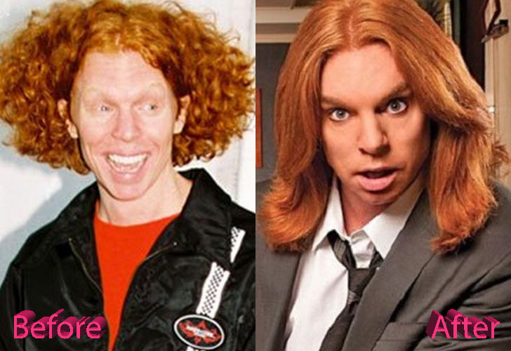 Carrot Top Plastic Surgery Not So Funny Anymore
