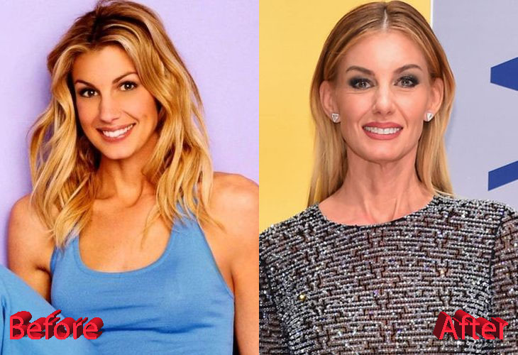 Faith Hill Plastic Surgery A Youthful Look For A Country Star