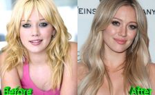 Hilary-Duff-Before-and-After-Cosmetic-Su