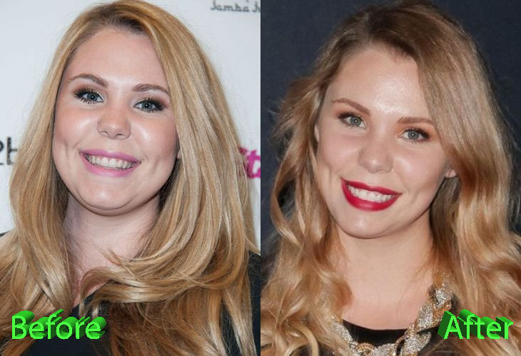 Kailyn Lowry Plastic Surgery Not Shy About It At All