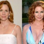 Melissa Gilbert Before and After Breast Implants Plastic Surgery 150x150