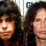 Steven Tyler before and after cosmetic treatments 150x150