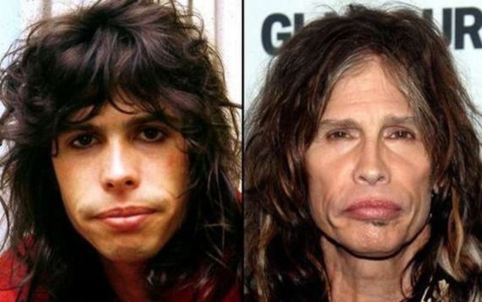Steven Tyler before and after cosmetic treatments