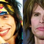 Steven Tyler plastic surgery before and after 150x150