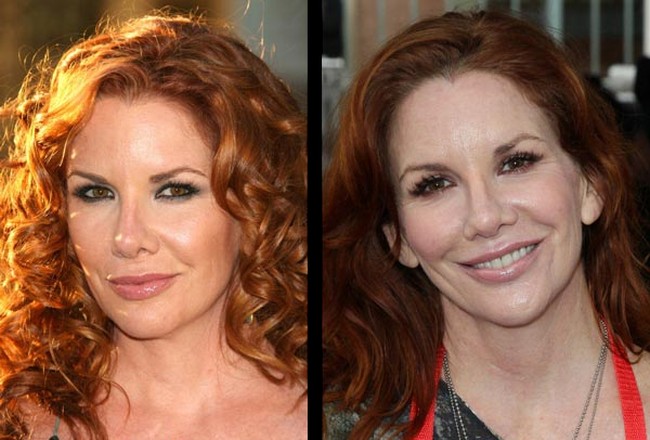 melissa gilbert plastic surgery before and after
