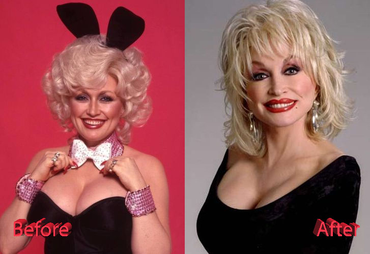 Dolly Parton Before and After Facelift