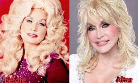 Dolly Parton Plastic Surgery Secrets: Confessions, Filler Mishaps & The Unfiltered Truth 💖