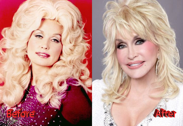 Dolly Parton Before and After Plastic Surgery