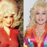 Dolly Parton Before and After Surgery Transformation