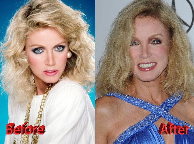Donna Mills Before and After Plastic Surgery