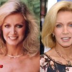 Donna Mills Facelift Before and After
