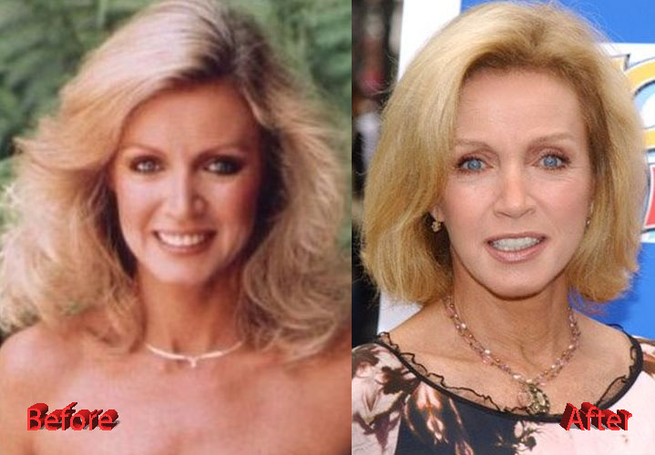 Donna Mills Facelift Before and After