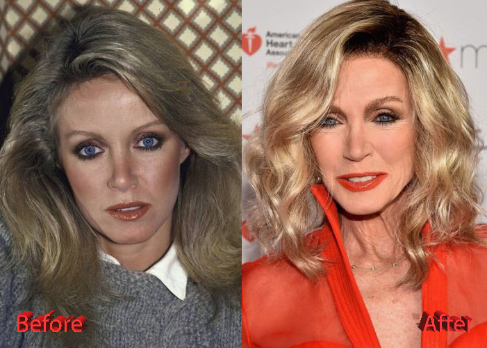Donna Mills Plastic Surgery Transformation