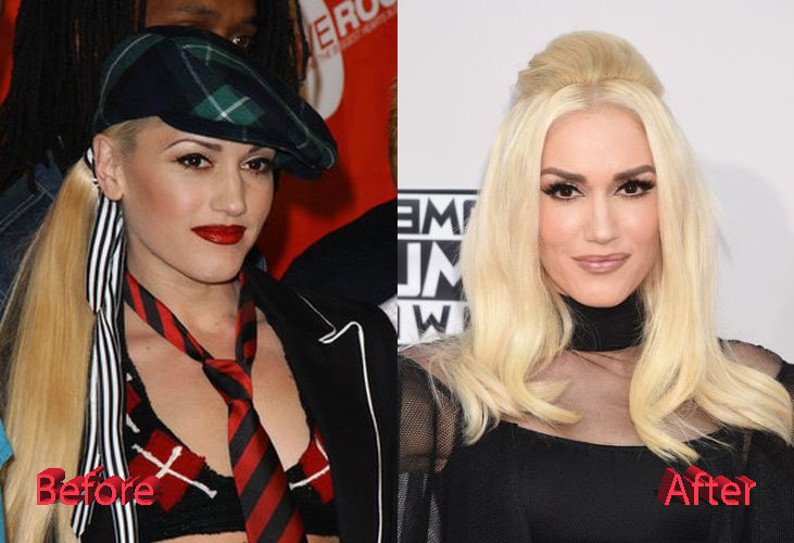 Gwen Stefani Before and After Facelift