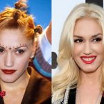 Gwen Stefani Before and After Surgery 150x150