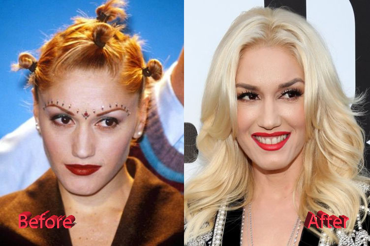 Gwen Stefani Before and After Surgery