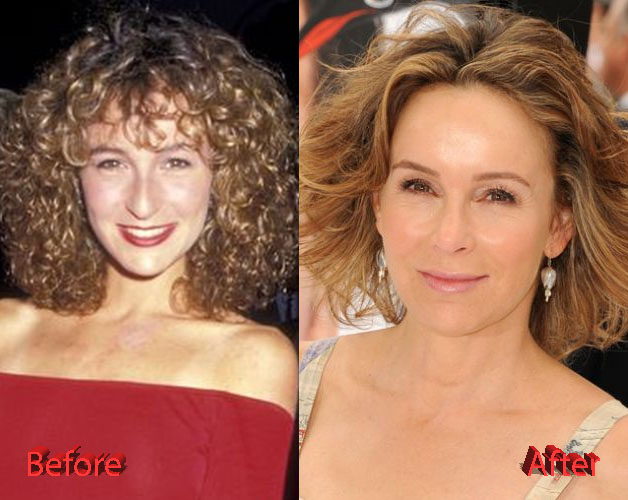 Jennifer Grey Rhinoplasty Fail