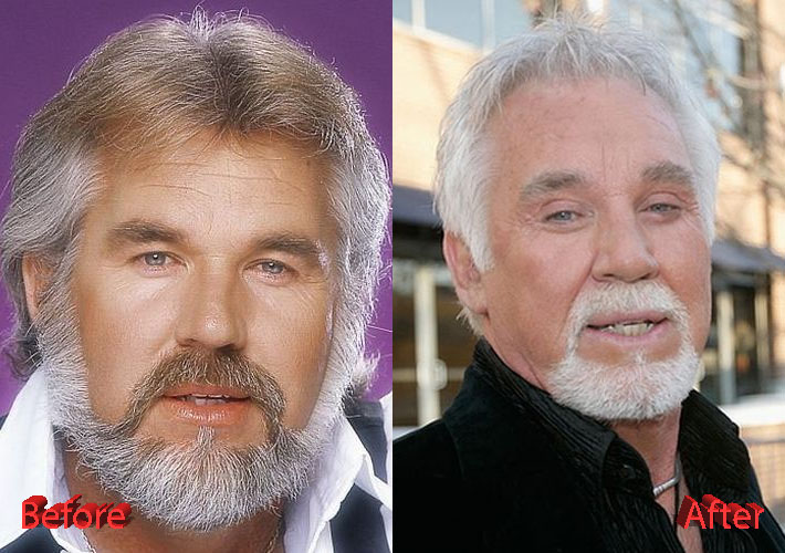 Kenny Rogers Plastic Surgery discussions are aplenty online and in the medi...