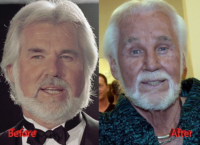 Kenny Rogers Plastic Surgery An Obsession with it