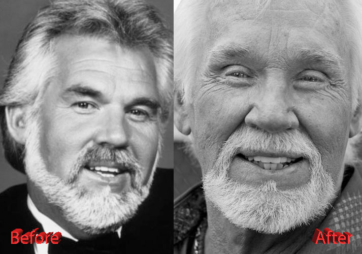Kenny Rogers Plastic Surgery An Obsession with it