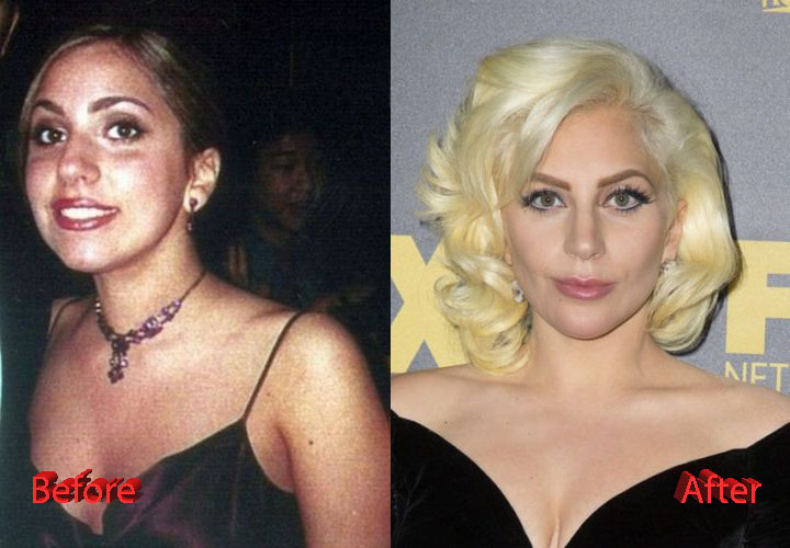 Lady Gaga Before and After Plastic Surgery