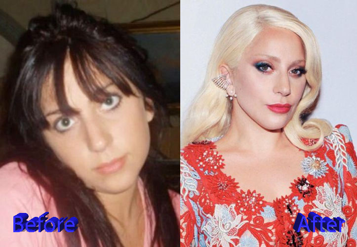 Lady Gaga Before and After Plastic Surgery2