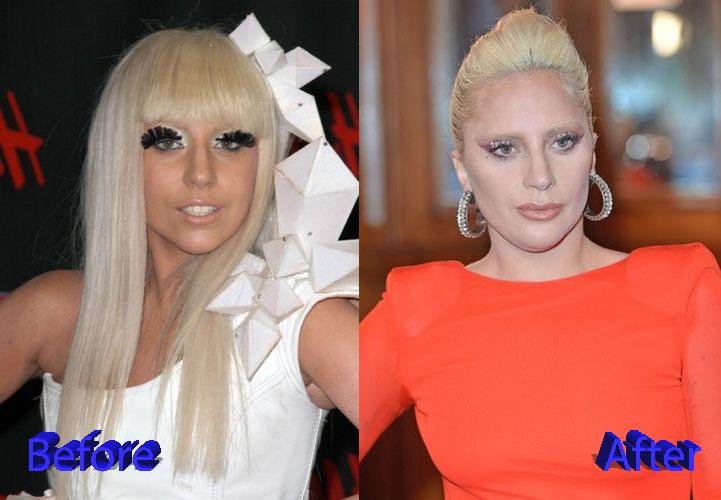 Lady Gaga Before and After Plastic Surgery3