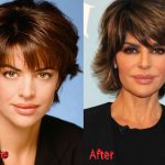 Lisa Rinna Before and After Surgery 150x150