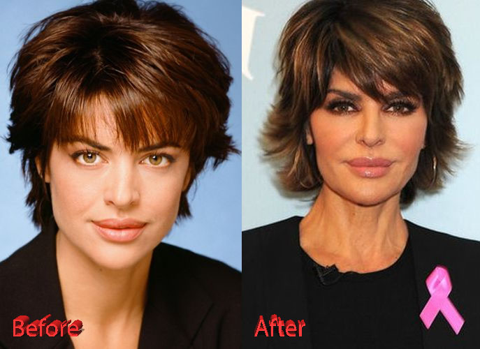 Lisa Rinna Before and After Surgery