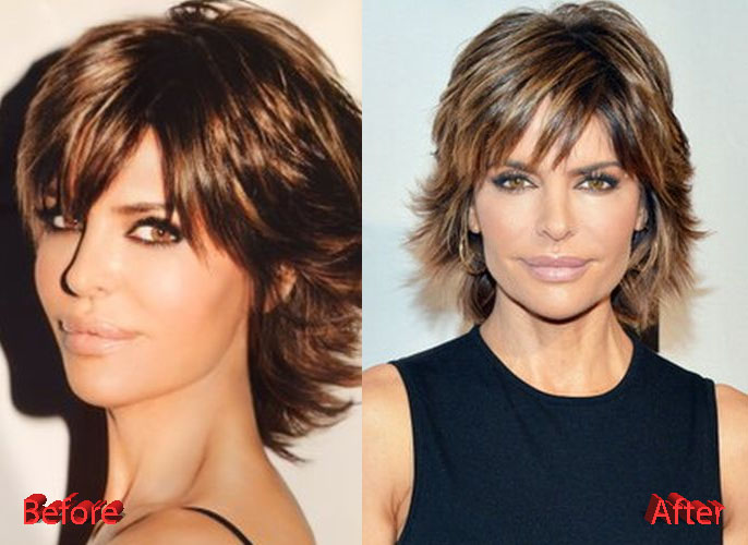 Lisa Rinna Surgery Fail