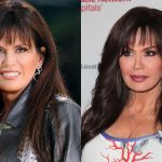 Marie Osmond Facelift 150x150