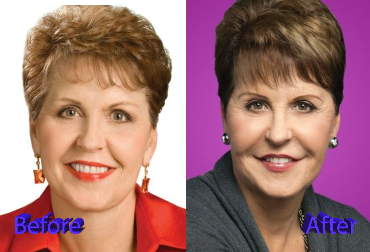 Joyce Meyer Plastic Surgery: A Huge Flop.