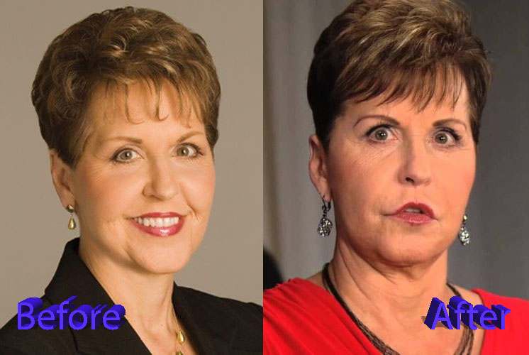 Joyce Meyer Plastic Surgery Before and After3