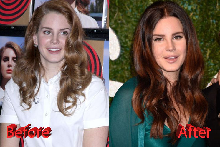 Lana Del Rey Plastic Surgery Before and After