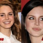 Lana Del Rey Plastic Surgery Before and After2 150x150