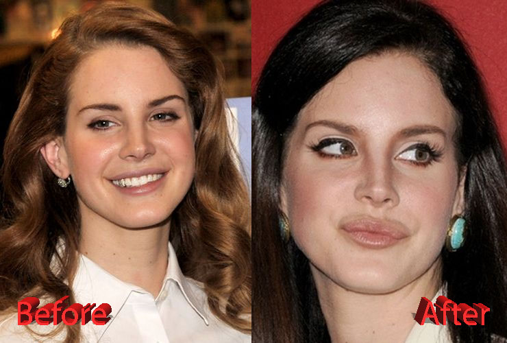 Lana Del Rey Plastic Surgery Before and After2