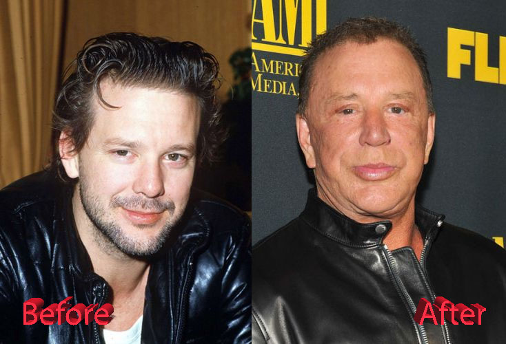 Mickey Rourke Plastic Surgery