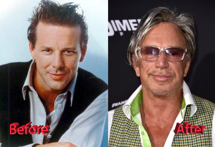 Mickey Rourke Plastic Surgery3