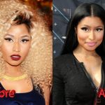 Nicki Minaj Plastic Surgery Before and After 150x150