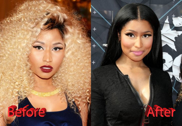 Nicki Minaj Plastic Surgery Before and After