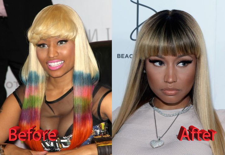 Nicki Minaj Plastic Surgery Before and After2