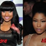 Nicki Minaj Plastic Surgery Before and After3 150x150