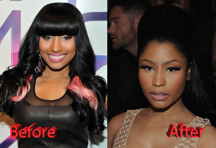 Nicki Minaj Plastic Surgery Before and After3