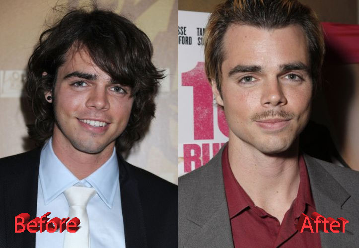 Reid Ewing Plastic Surgery Before and After3