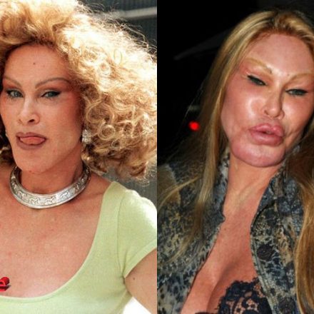 Catwoman Plastic Surgery Disaster - Plastic Surgery Mistakes