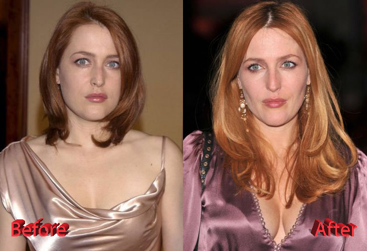 Gillian Anderson Plastic Surgery Before and After